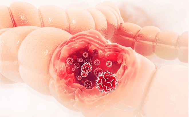 Ăn thế nào khi bị bệnh viêm loét đại tràng